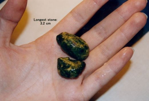 gallstones